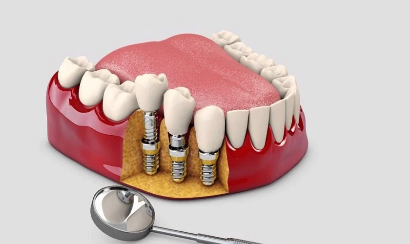 Giải đáp: Mất răng lâu năm có trồng Implant được không?