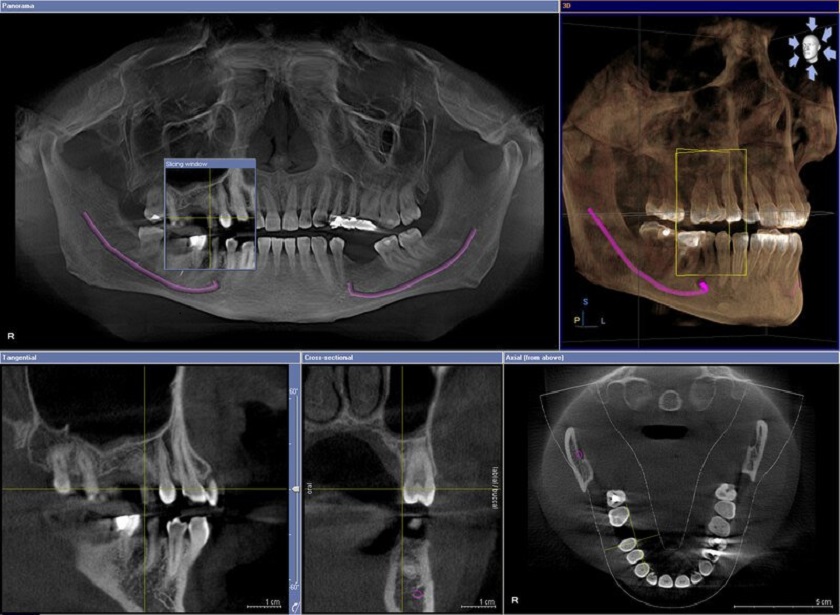 Các trường hợp trong nha khoa cần chụp CT Cone Beam 3D