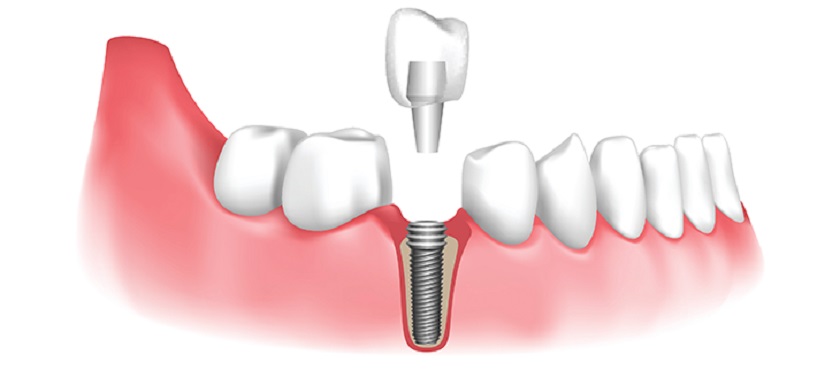 Cấy ghép răng Implant – kỹ thuật phục hình răng tiên tiến nhất