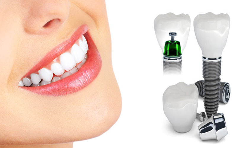 Cấy ghép răng Implant có nhiều ưu điểm vượt trội hơn so với cầu răng sứ