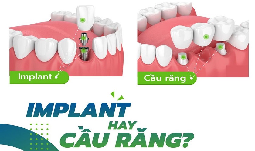 Nên làm cầu răng hay Implant để phục hình răng mất