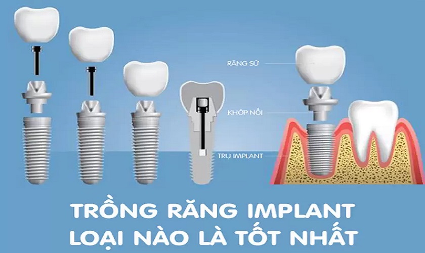 Nên trồng răng Implant loại nào là tốt nhất?