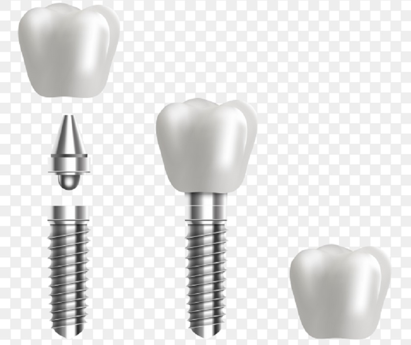 Chất lượng vật liệu cấy ghép là một yếu tố cần đánh giá khi tìm hiểu nên trồng răng Implant ở đâu