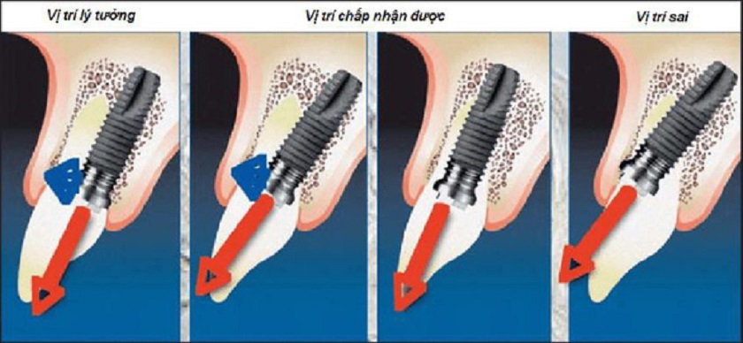 Mô phỏng vị trí đặt trụ chân răng trong xương hàm