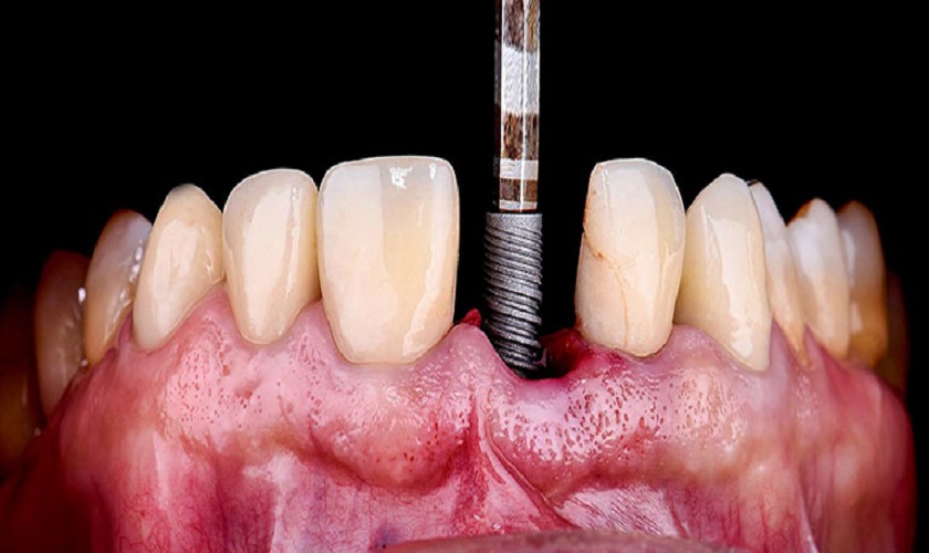 Những nguy hiểm tiềm tàng khi trồng răng Implant thất bại