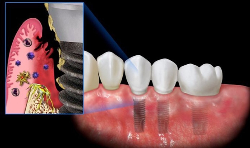Dấu hiệu nhận biết răng Implant bị nhiễm trùng