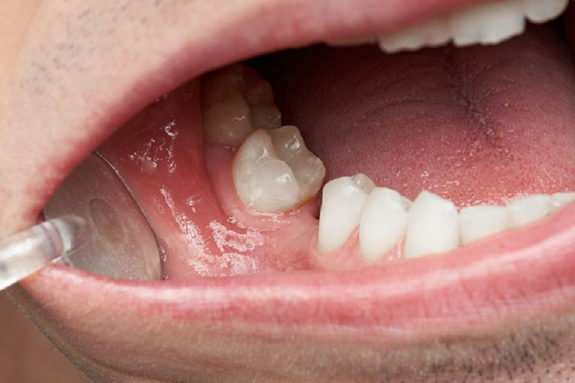 Mất răng lâu năm có thể làm mất đi tính ổn định giữa các răng