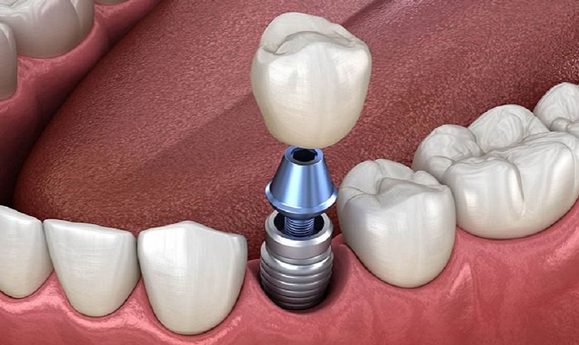 Nhổ răng quá lâu có trồng được răng Implant không?