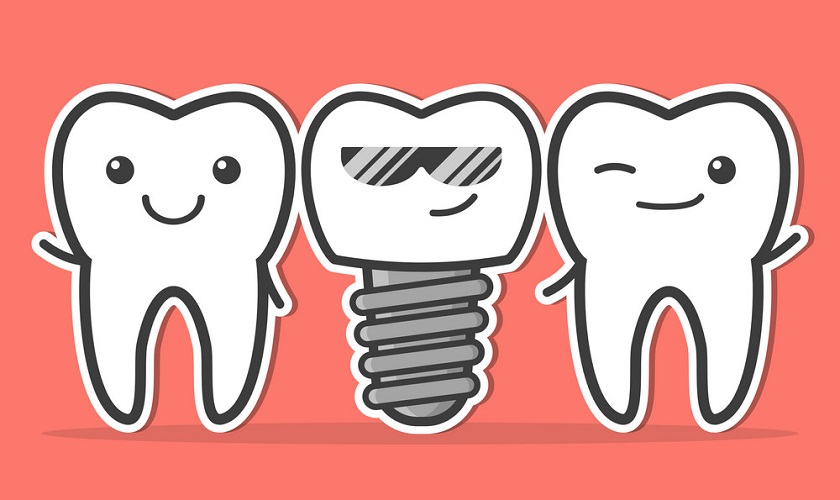Những điều kiện trồng răng Implant cần đảm bảo