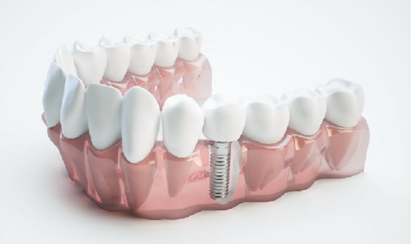 Nhược điểm của trồng răng Implant bạn cần biết khi thực hiện