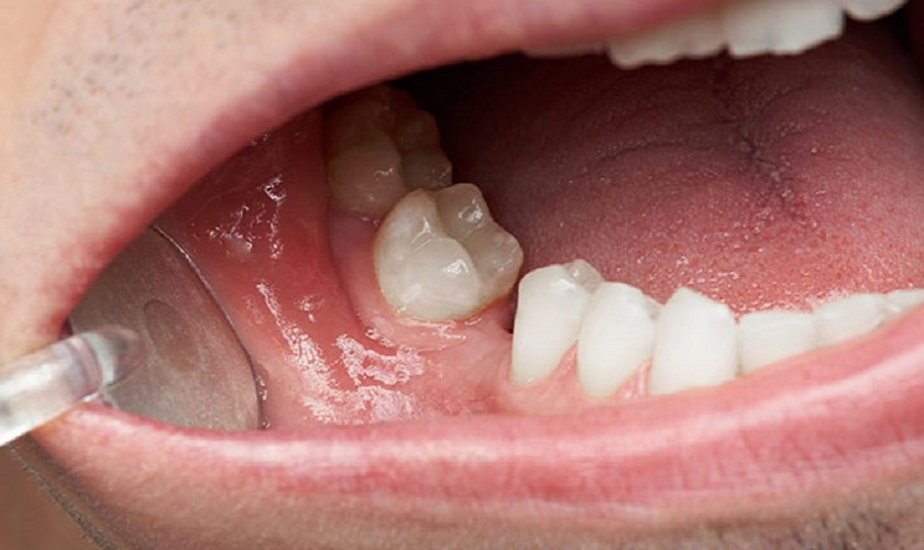 Những trường hợp nào cần thực hiện nong xương khi trồng răng Implant?