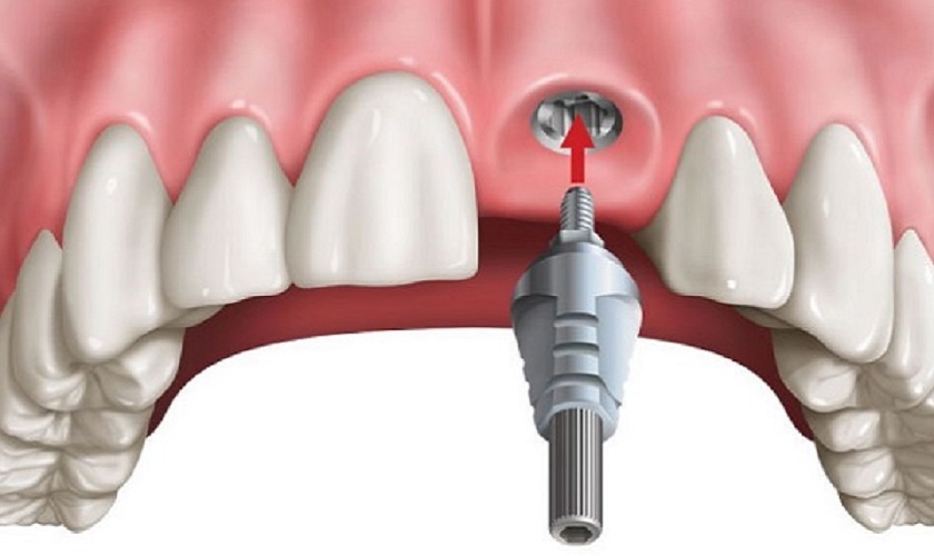 Cấy trụ chân răng vào xương hàm trong trồng răng Implant
