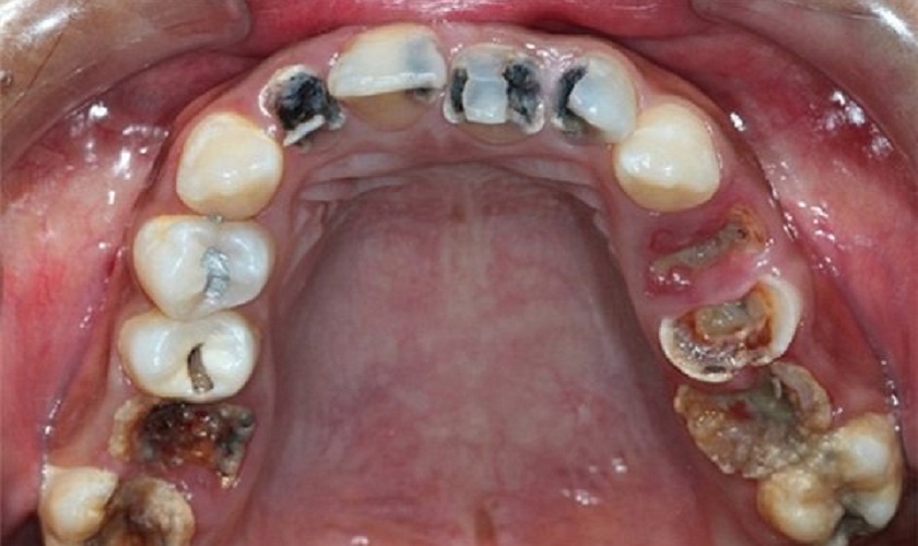 Sâu răng, viêm tủy có thể dẫn đến gãy răng, rụng răng