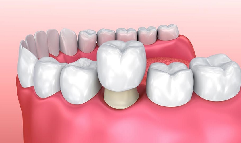 Bọc sứ có thể khôi phục răng gãy vỡ