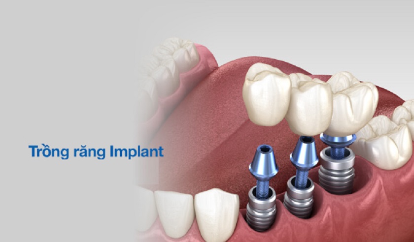 Trồng răng Implant là phương pháp tốt nhất giúp khôi phục răng đã gãy rụng