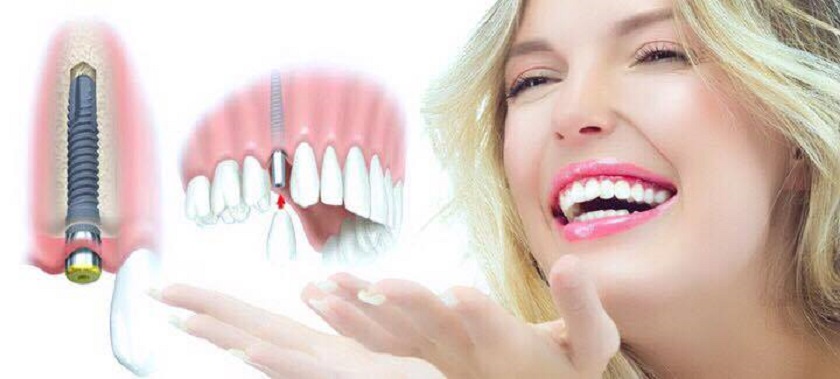 Răng Implant có độ bền chắc và tuổi thọ dài lâu
