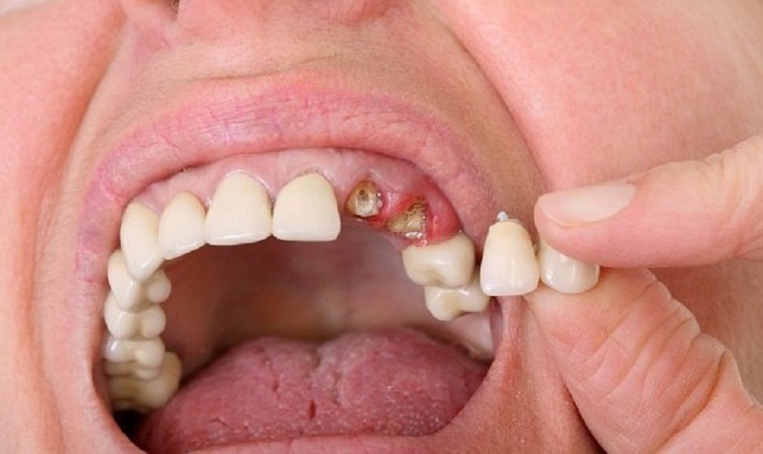Rụng răng bị gãy nên xử lý như thế nào?