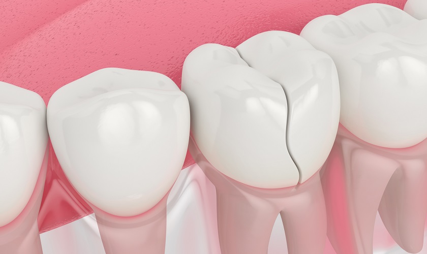Răng bị nứt có nguy hiểm không? Xử lý thế nào?