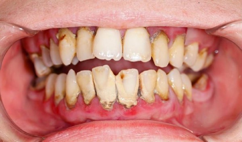 Mảng bám của cao răng