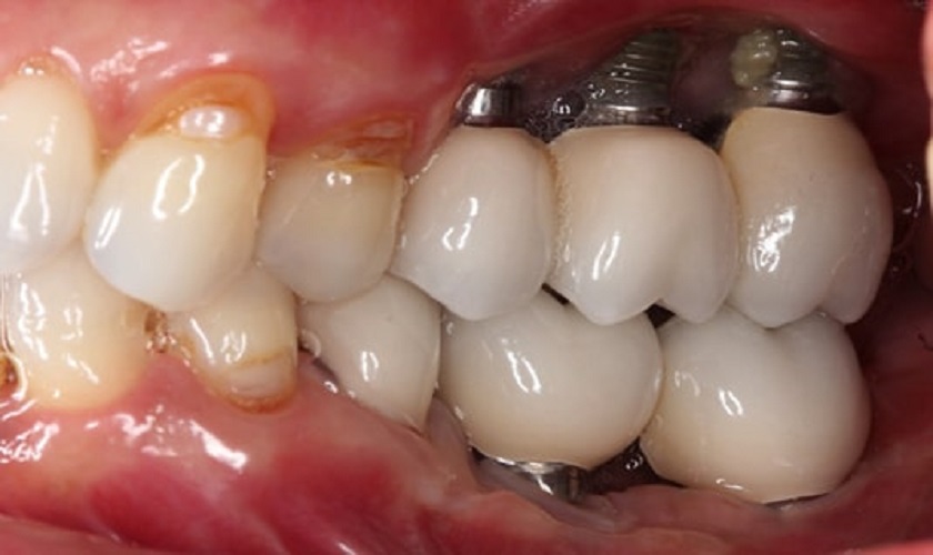 Hiện tượng răng Implant bị đào thải sau một thời gian cấy ghép