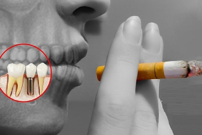 Hút thuốc lá thường xuyên là nguyên nhân hàng đầu khiến răng Implant bị đào thải