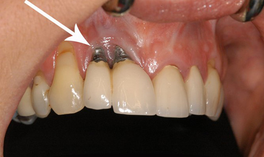 Lộ rõ thân trụ Implant cho thấy răng giả đã bị đào thải