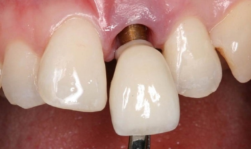 Răng Implant bị đào thải - Nguyên nhân và cách khắc phục
