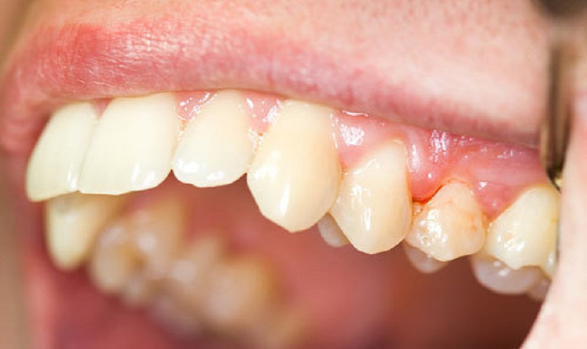 Viêm viêm nha chu không được chữa trị triệt để trước khi cấy ghép sẽ khiến răng Implant bị đau nhức