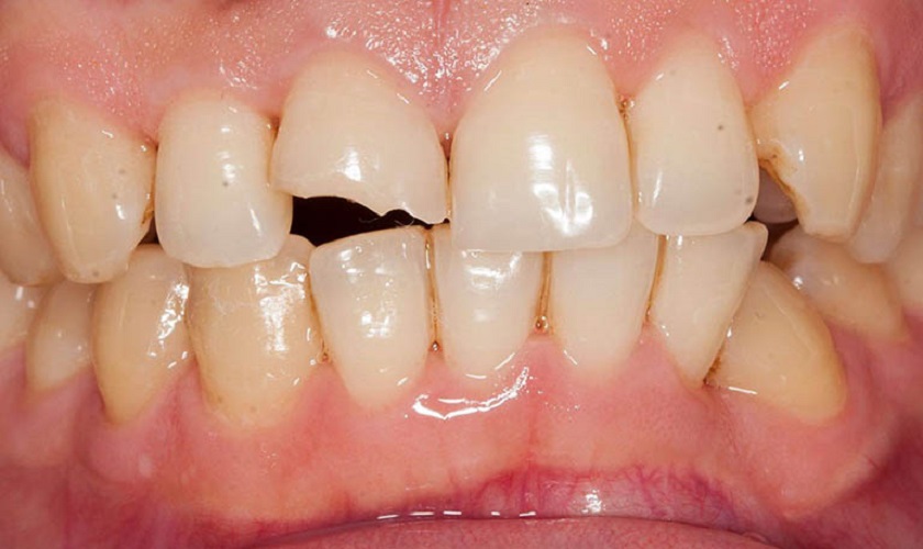 Răng Implant bị vỡ: Nguyên nhân và cách điều trị