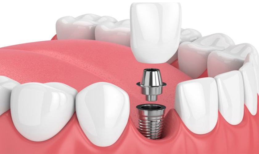 Răng Implant đơn lẻ