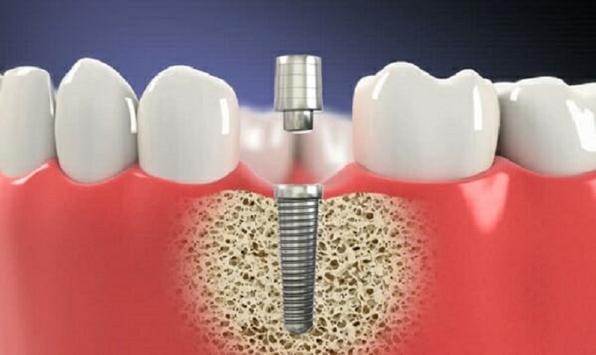 Trong nha khoa trụ Implant có chức năng thay thế chân răng đã mất