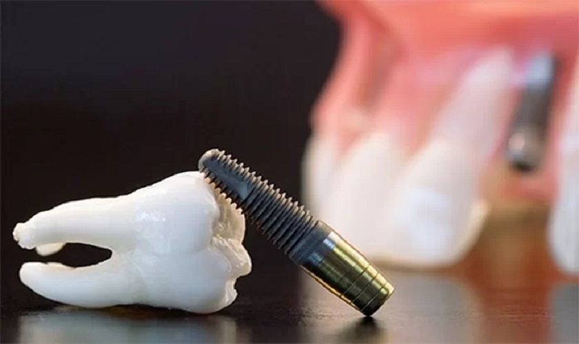 Kinh nghiệm chọn trụ trồng răng Implant loại nào tốt nhất?