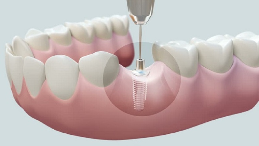 Tại sao răng Implant lại bền hơn so với các phương pháp khác