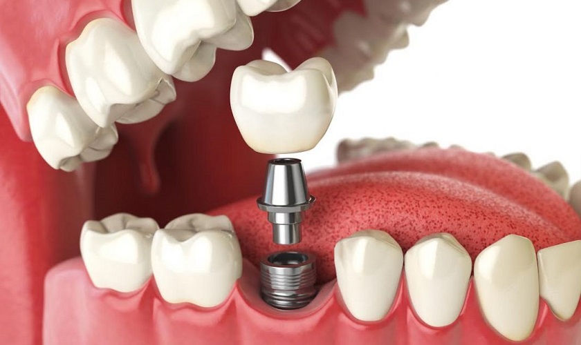Răng Implant tồn tại bao lâu? Chia sẽ chăm sóc răng Implant