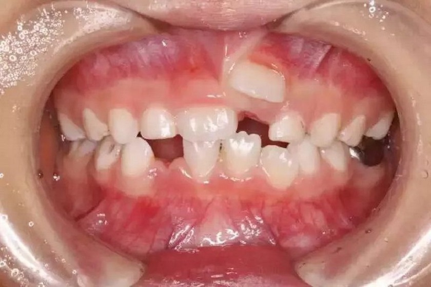 Nguyên nhân hiện tượng răng mọc lẫy