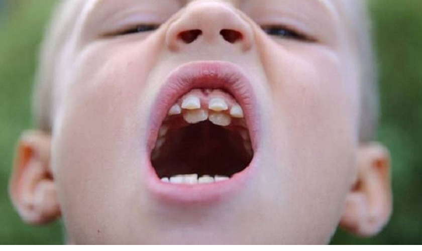 Răng mọc lẫy: Nguyên nhân và cách điều trị