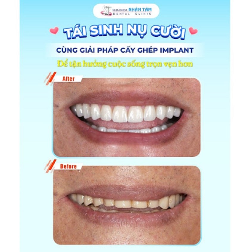 Cận cảnh khách hàng trồng răng Implant tại Nha khoa Nhân Tâm
