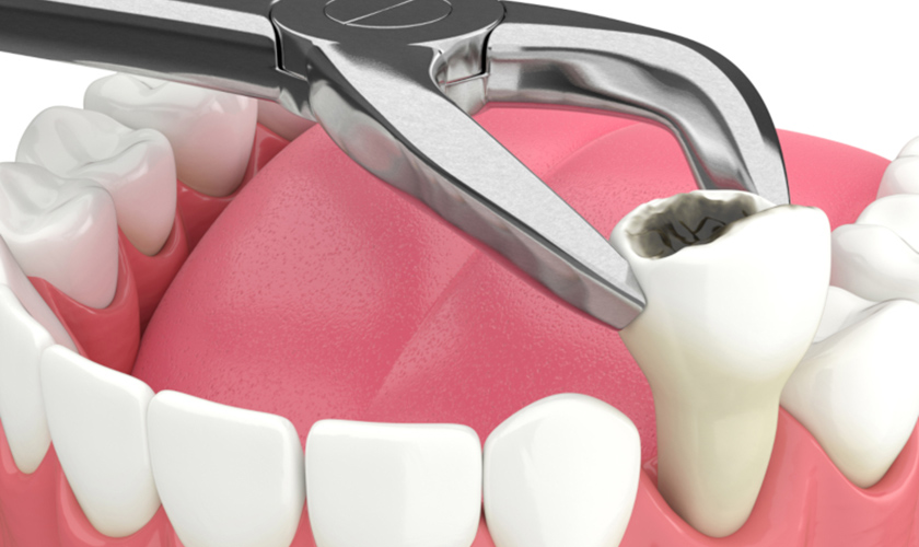 Sau khi nhổ răng bao lâu thì trồng Implant được?