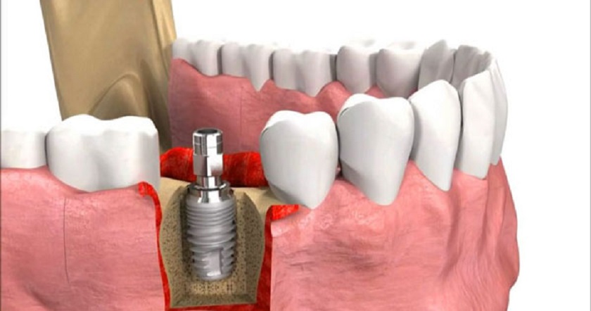 Cắm Implant tức thì sau nhổ răng trong trường hợp xương hàm khỏe mạnh