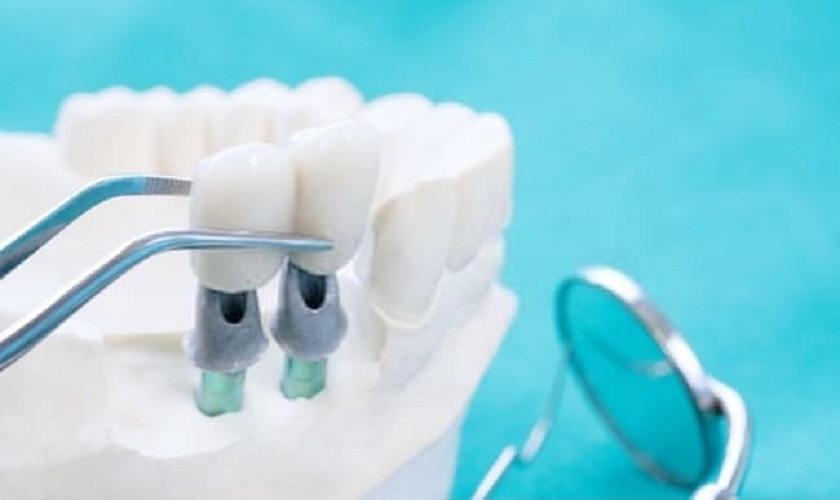 [Hỏi&Đáp] Sau khi nhổ răng bao lâu thì có thể trồng răng Implant?
