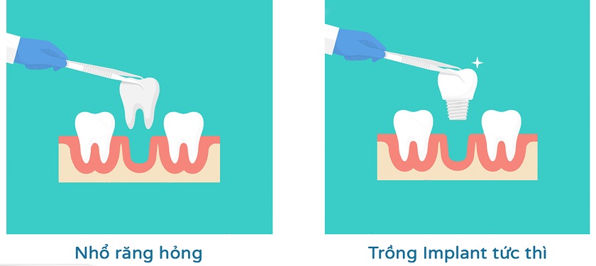 Có thể kết hợp nhổ răng trồng Implant ngay trong 1 lần phẫu thuật