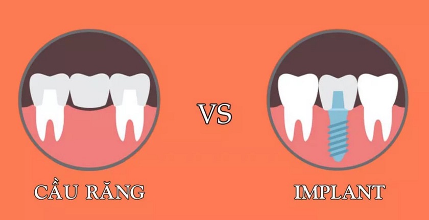 So sánh giữa cầu răng sứ và trồng răng Implant