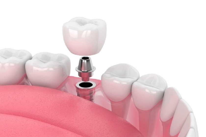 Ưu nhược điểm trồng răng Implant