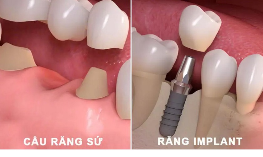 So sánh giữa làm cầu răng và trồng răng Implant