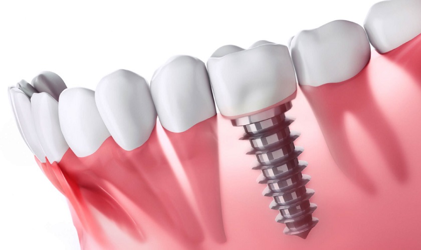 Tại sao trồng răng Implant giá lại cao hơn các phương pháp khác?