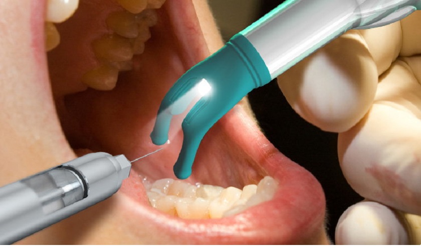 Giới thiệu thiết bị DentalVibe tiêm tê không đau tại nha khoa