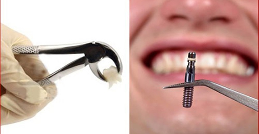 Cấy ghép Implant có thể tiến hành ngay sau khi nhổ răng