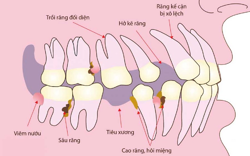 Tiêu xương hàm gây ra hậu quả thế nào tới răng miệng?