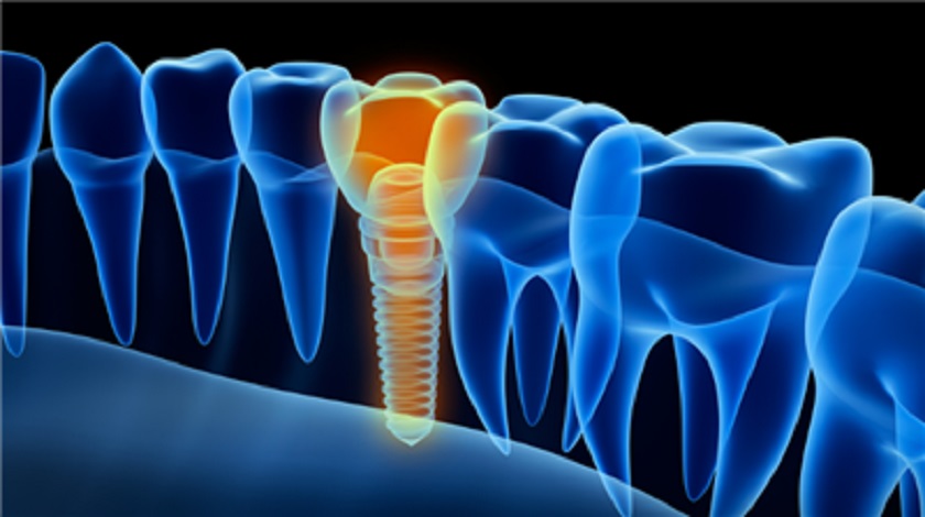 Răng Implant sẽ không được vững chắc sau khi trồng nếu xương hàm của bạn đã bị tiêu biến