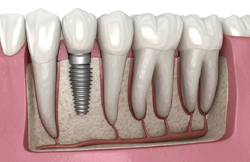 Trồng răng Implant là kỹ thuật phục hình răng khắc phục tiêu xương hàm hiệu quả nhất hiện nay